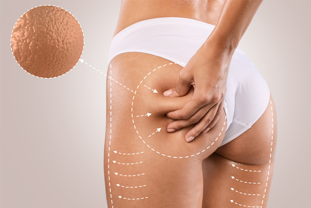 jaki jest skuteczny krem antycellulitowy dla kobiet recenzja serum celleasy
